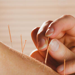 Dry Needling