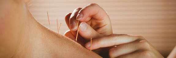 Dry Needling