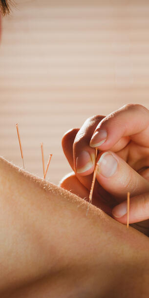 Dry Needling